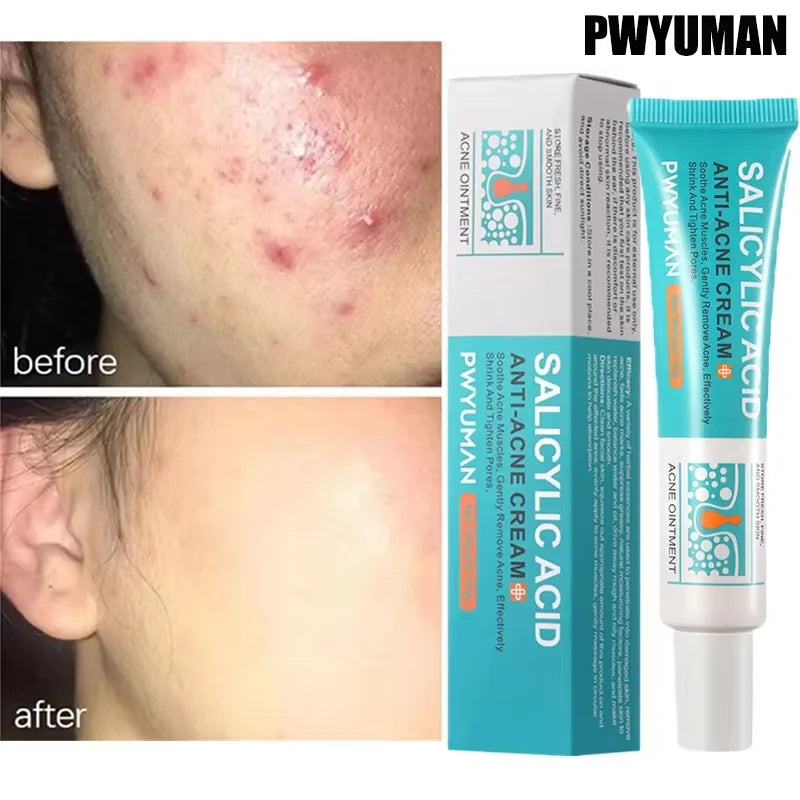 Salicylic Acid Acne Treatment Cream - Pimple Spot Repair, Pore Cleansing & Oil Control Skincare