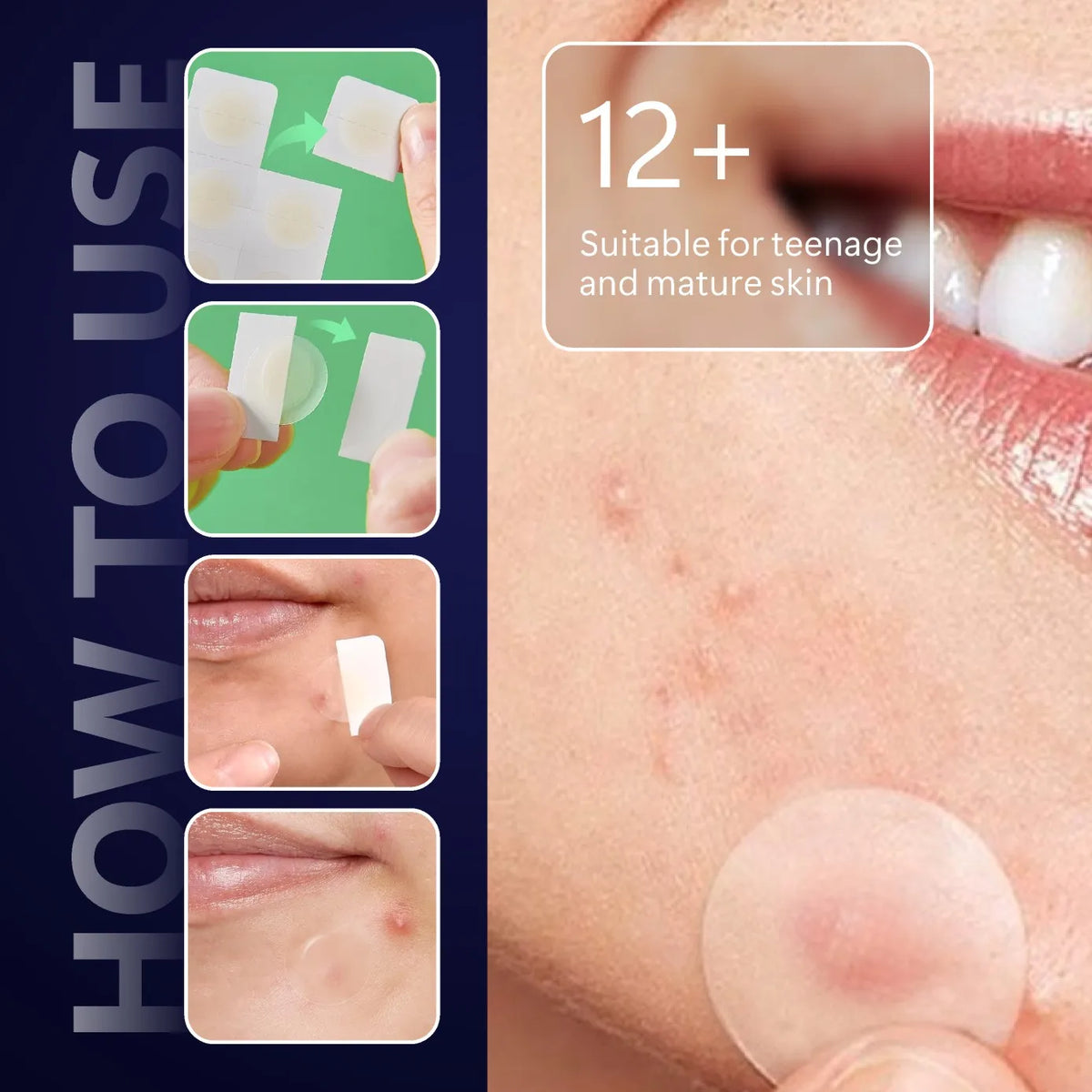 Microneedle Pimple Patches - 24-Pack Hydrocolloid Microdart Acne & Blemish Treatment Patches