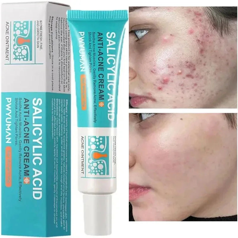 Effective Acne Removal Cream – Anti-Acne Gel for Redness, Pimples, Deep Pore Cleaning & Oil Control Skin Care