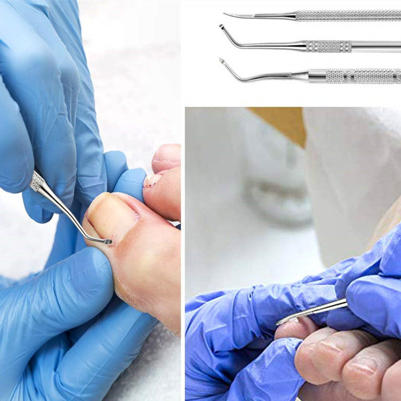 3PCS Stainless Steel Ingrown Toenail Tool Kit – Toenail File, Lifters, and Pedicure Tools for Pain Relief and Nail Care