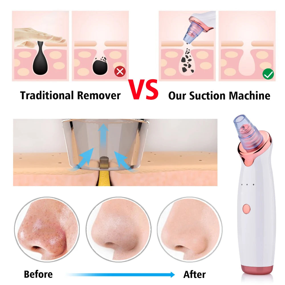 Electric Facial Blackhead Remover: Vacuum Pore Cleaner for Acne Cleansing & Black Spot Removal - Deep Cleaning Tools for Face and Nose