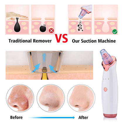 Electric Facial Blackhead Remover: Vacuum Pore Cleaner for Acne Cleansing & Black Spot Removal - Deep Cleaning Tools for Face and Nose