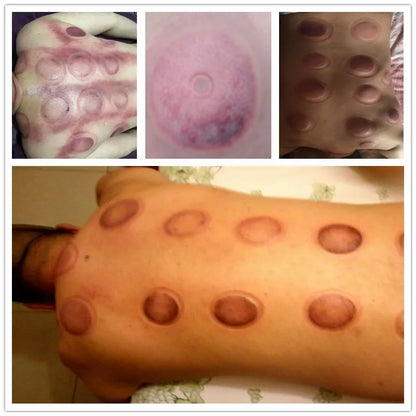 18pcs Suction Cup Cupping Set — TCM Magnetic Acupressure Vacuum Therapy for Whole Body Muscle Pain Relief Massage