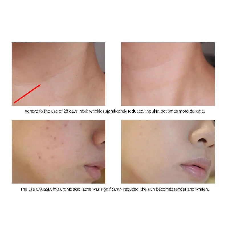 ARTISCARE Hyaluronic Acid Serum & VC Essence Cream - 10PCS Moisturizing Facial Care for Acne, Aging & Wrinkle Care