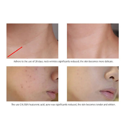 ARTISCARE Hyaluronic Acid Serum & VC Essence Cream - 10PCS Moisturizing Facial Care for Acne, Aging & Wrinkle Care