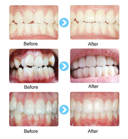 T4K Children’s Dental Tooth Trainer – Orthodontic Appliance for Kids Teeth Alignment, Soft & Hard Braces Mouthpieces