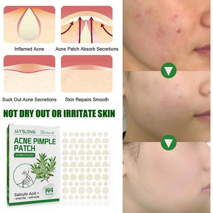 144 Pack Acne Pimple Patches – Translucent Matte Hydrocolloid with Salicylic Acid & Tea Tree Oil for Whiteheads & Inflamed Acne