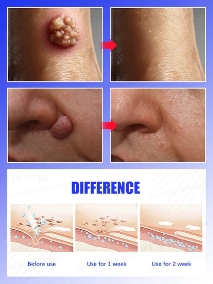 Quick Wart & Sarcoma Removal Treatment – Fast & Effective Skin Care Solution