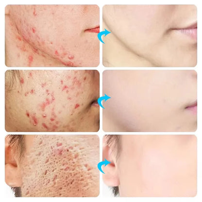 Effective Acne Removal Cream – Anti-Acne Gel for Redness, Pimples, Deep Pore Cleaning & Oil Control Skin Care