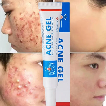 Effective Acne Removal Cream 30g – Anti-Acne Gel for Redness, Pimples, Deep Pore Cleaning & Oil Control Skin Care