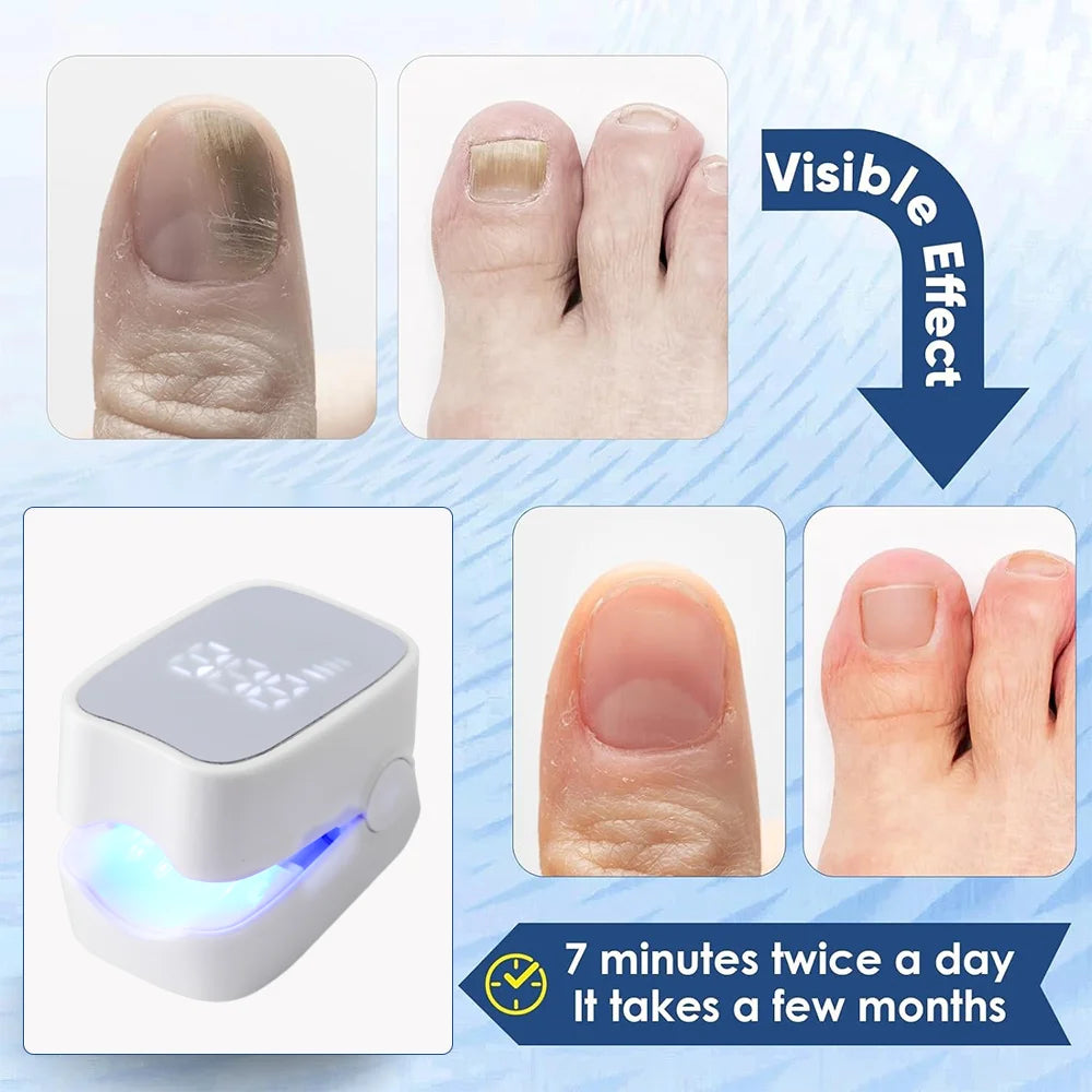 Nail Fungus Treatment Tools – Effective Anti-Fungal Equipment for Toenail & Nail Infection Removal