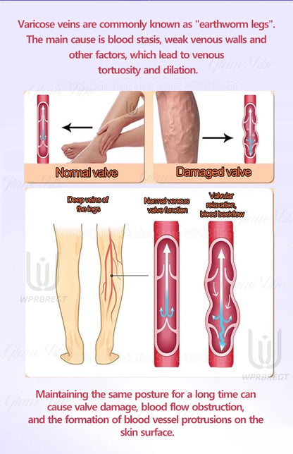 2nd Gen Varicose Vein Laser Therapy Device – Relieves Spider Leg Pain, Treats Vasculitis & Phlebitis