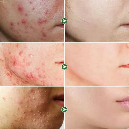 Effective Acne Removal Cream 30g – Anti-Acne Gel for Redness, Pimples, Deep Pore Cleaning & Oil Control Skin Care