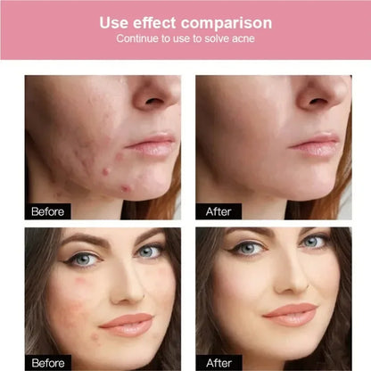 72/180-Piece Hydrocolloid Acne Patches - Waterproof Invisible Pimple Cover Stickers with Printed Designs
