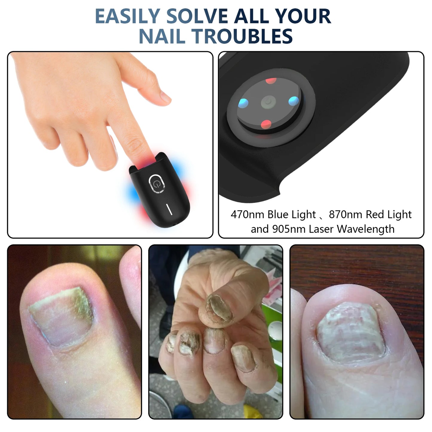 Fast Nail Fungus Repair with Fungal Nail Laser Device - Effective Onychomycosis Treatment