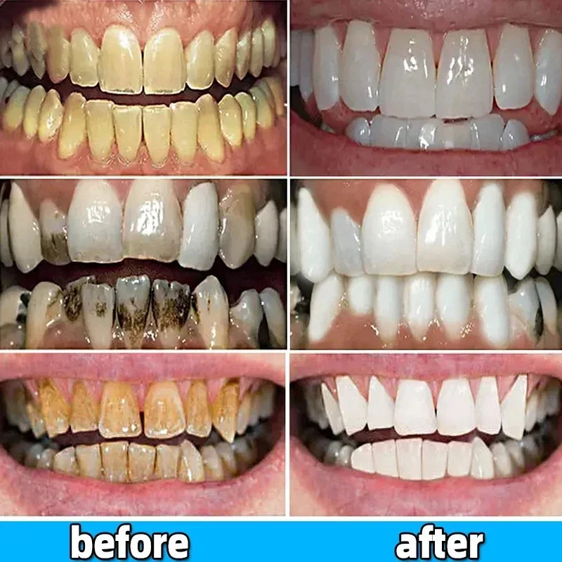 Dental Calculus Remover – Bad Breath & Whitening Teeth Care, Prevent Periodontitis & Brighten Smile