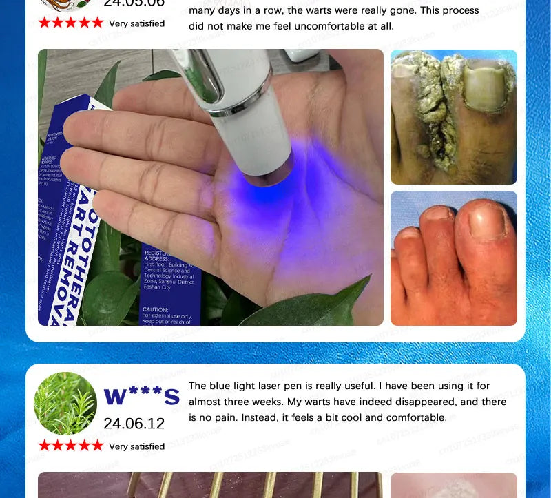 Safe Skin-Friendly Wart Removal Methods – Gentle Solutions for Effective Wart Treatment