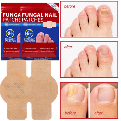 21/105pcs Waterproof Nail Fungus Repair Patches — Ingrown Nail Correction Stickers for Damaged Nail & Feet Care