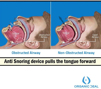 Anti-Snoring Silicone Mouthpiece – Tongue Retainer Device for Snore & Sleep Apnea Relief