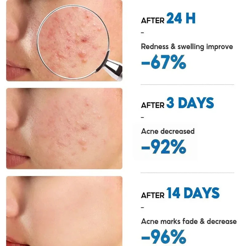 Salicylic Acid Acne Removal Cream – Anti-Acne, Redness Repair, Deep Cleaning & Oil Control Skincare