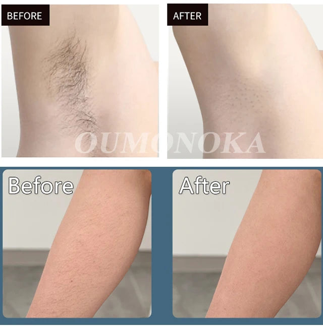 Body Bikini IPL Hair Removal Device — 999,999 Flashes Permanent Painless Laser Epilator for Women, Home Use