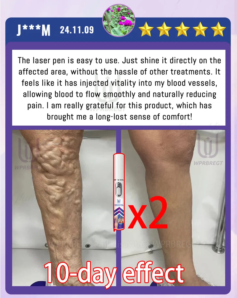 Varicose Vein & Spider Leg Pain Relief Treatment — Painless Care for Vasculitis & Phlebitis