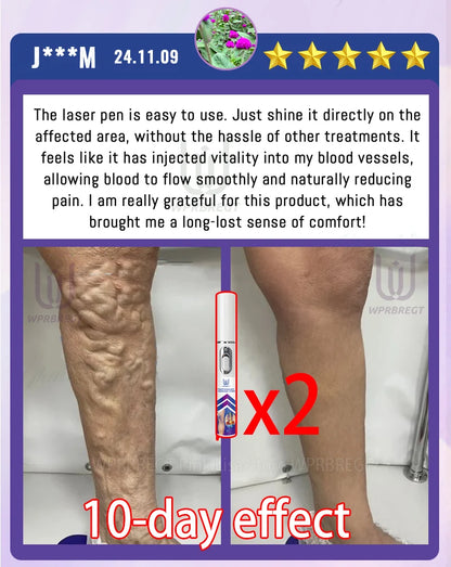 2nd Gen Varicose Vein Laser Therapy Device – Relieves Spider Leg Pain, Treats Vasculitis & Phlebitis