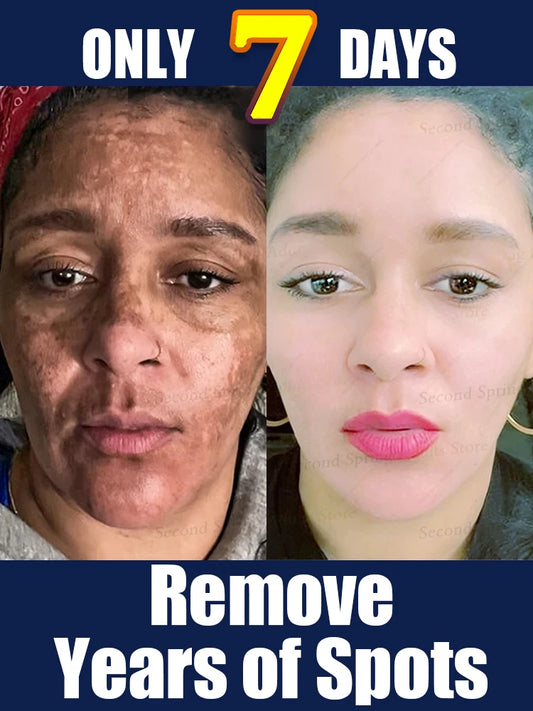 Melasma Spot Care Tool - 2025 Upgraded Skin Cleaning & Dark Spot Treatment Device