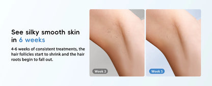 IPL Hair Removal Laser 22J — Unlimited Flashes IGBT, 5.2cm² Light Painless Epilator for Face, Armpit & Bikini Body Treatment
