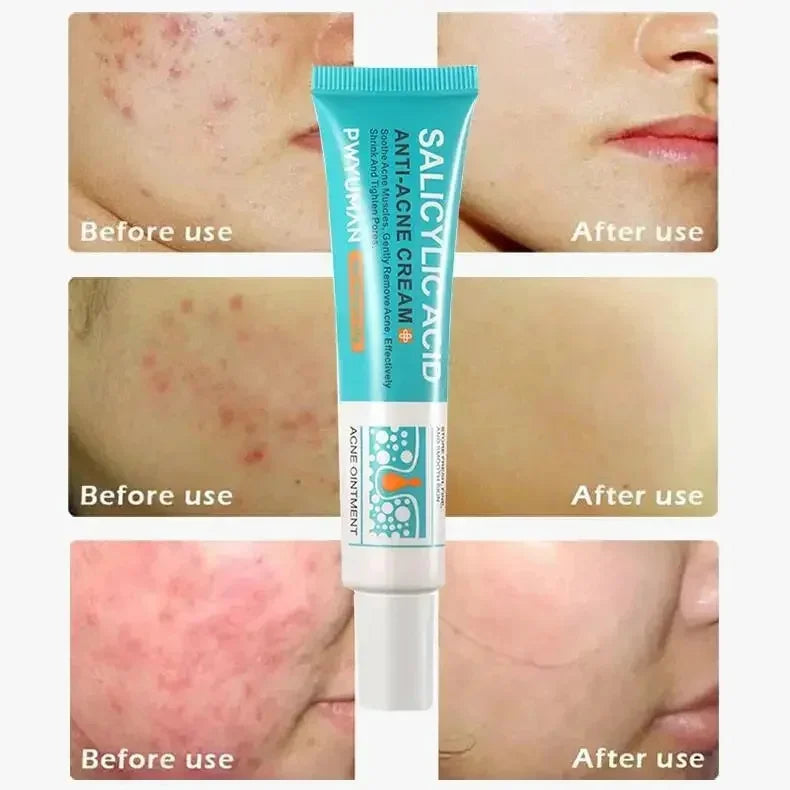 Effective Acne Removal Cream – Anti-Acne Gel for Redness, Pimples, Deep Pore Cleaning & Oil Control Skin Care