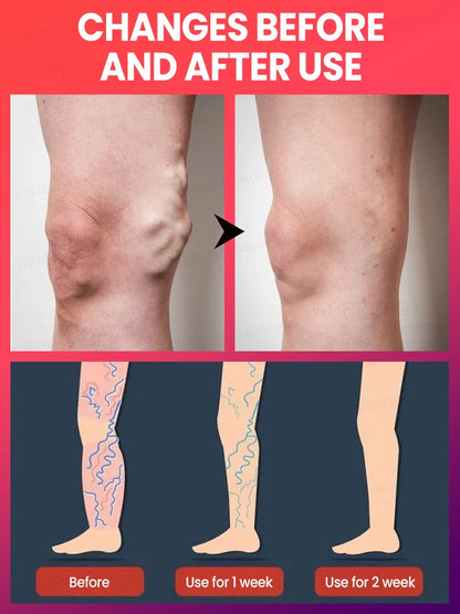 Medical-Grade Laser Treatment for Varicose & Spider Veins – Painless Leg Vein Therapy Equipment