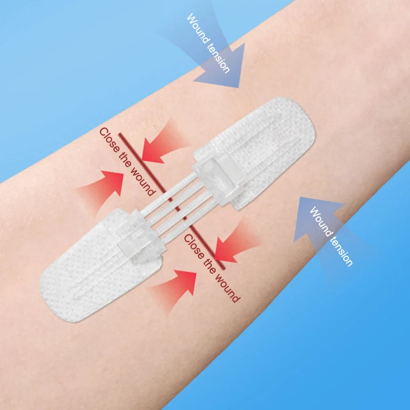 1–20-Piece Zipper Wound Closure Patch Set - Suture-Free Wound Dressing Strips for First Aid and Outdoor Care