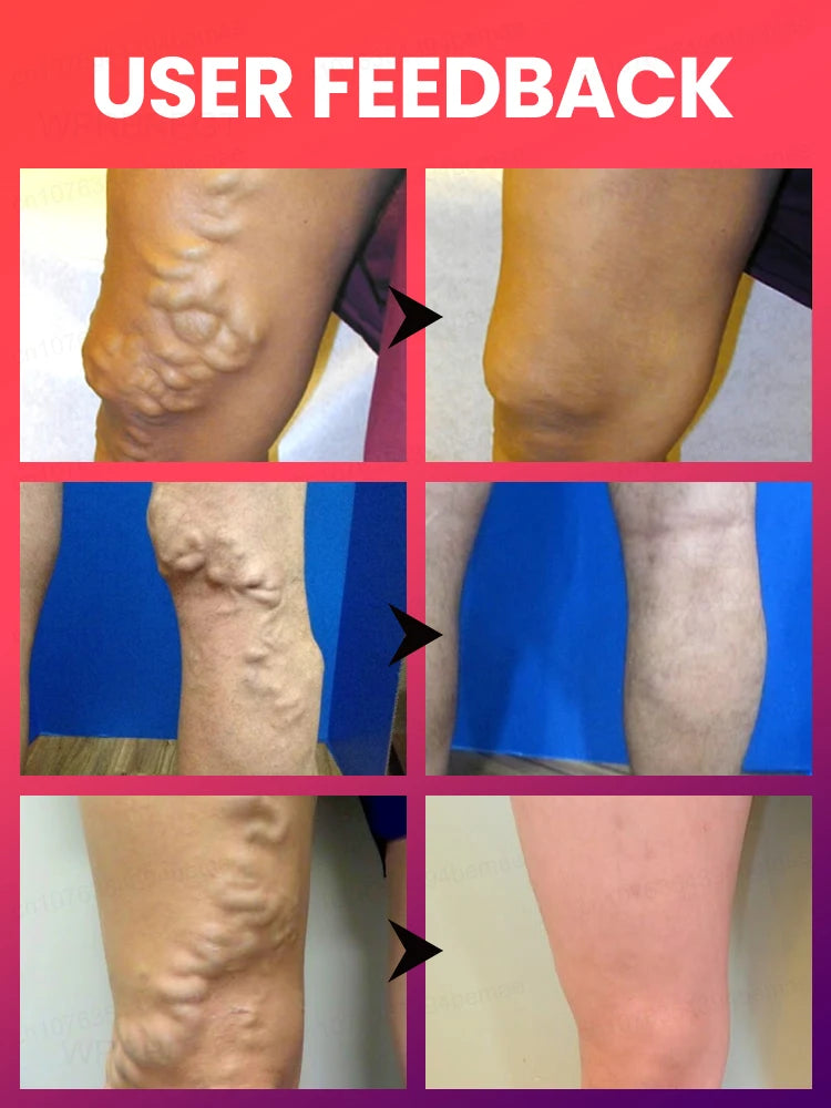 Medical-Grade Laser Treatment for Varicose & Spider Veins – Painless Leg Vein Therapy Equipment
