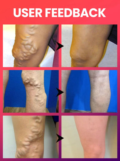 Medical-Grade Laser Treatment for Varicose & Spider Veins – Painless Leg Vein Therapy Equipment