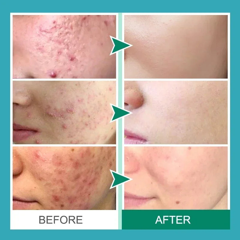 Salicylic Acid Acne Removal Cream – Anti-Acne, Redness Repair, Deep Cleaning & Oil Control Skincare