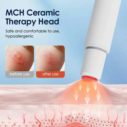 Portable Heat Therapy Bug Bite Relief Pen - Electric Mosquito Bite Itch Relief Device for Outdoor Travel & Daily Use