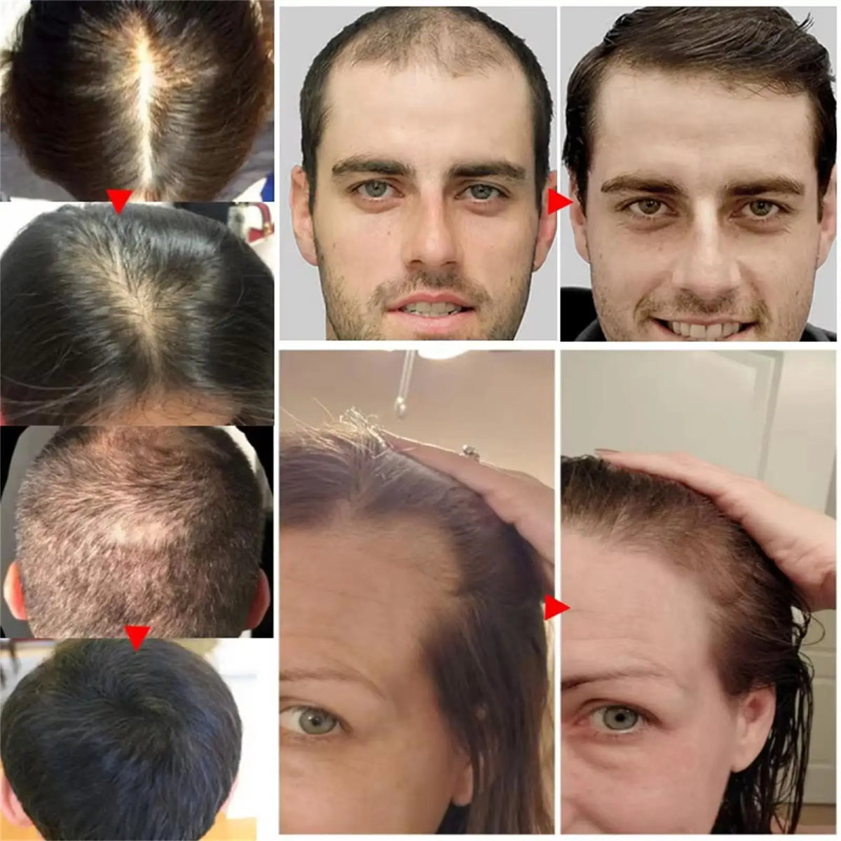 Ginger Hair Growth Serum Spray - Moisturizing Scalp Care and Nourishing Hair Treatment for Men and Women