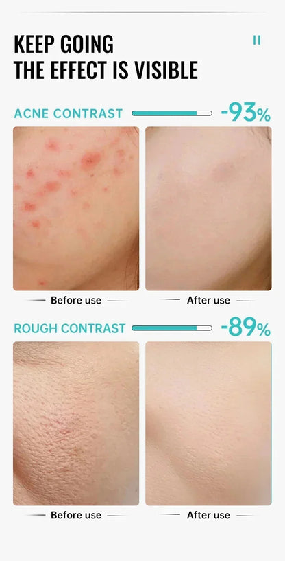 Effective Acne Removal Cream 30g – Anti-Acne Gel for Redness, Pimples, Deep Pore Cleaning & Oil Control Skin Care