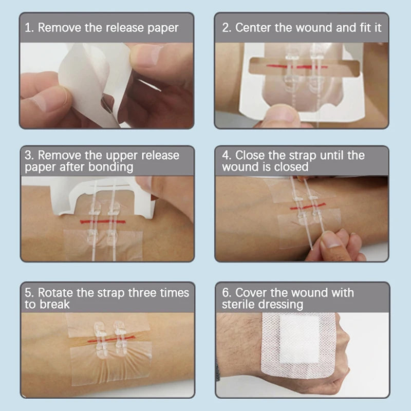 Camping Wound Closure Strips – Painless Adhesive Suture Patch for Fast Hemostatic Care & First Aid