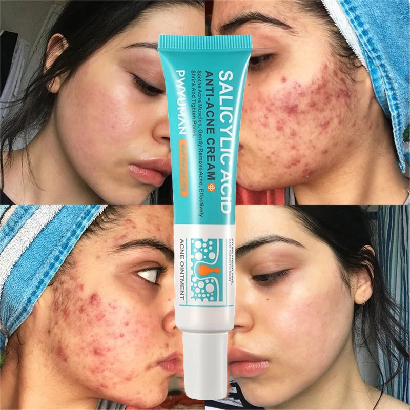 Salicylic Acid Acne Removal Cream – Anti-Acne, Redness Repair, Deep Cleaning & Oil Control Skincare