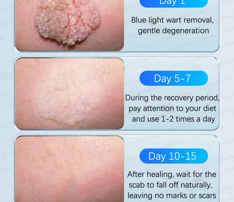 Safe Skin-Friendly Wart Removal Methods – Gentle Solutions for Effective Wart Treatment