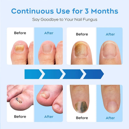 2-in-1 Fungal Nail Laser Device – Fast Repair for Toenail & Fingernail Fungus, Onychomycosis Treatment & Foot Care