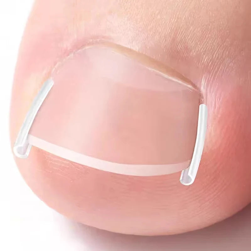 50PCS Ingrown Toenail Correction Kit – Invisible Nail Straightening Clips & Treatment Pads for Foot Care
