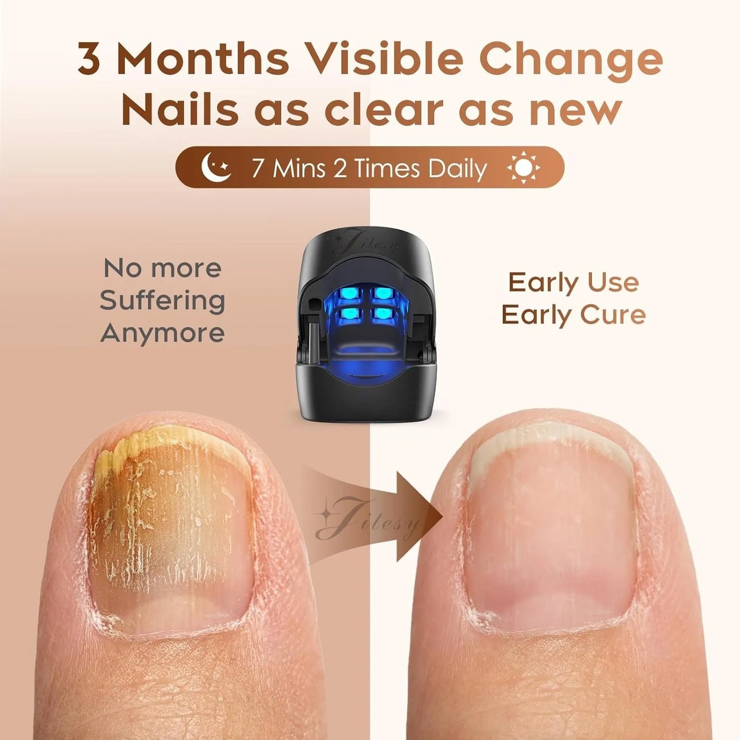 Nail Fungus Cleaning Light Device – USB Charge, 905nm Infrared & 470nm Blue Light for Onychomycosis Treatment
