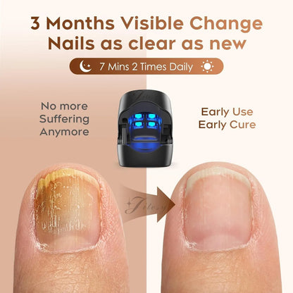 Nail Fungus Cleaning Light Device – USB Charge, 905nm Infrared & 470nm Blue Light for Onychomycosis Treatment