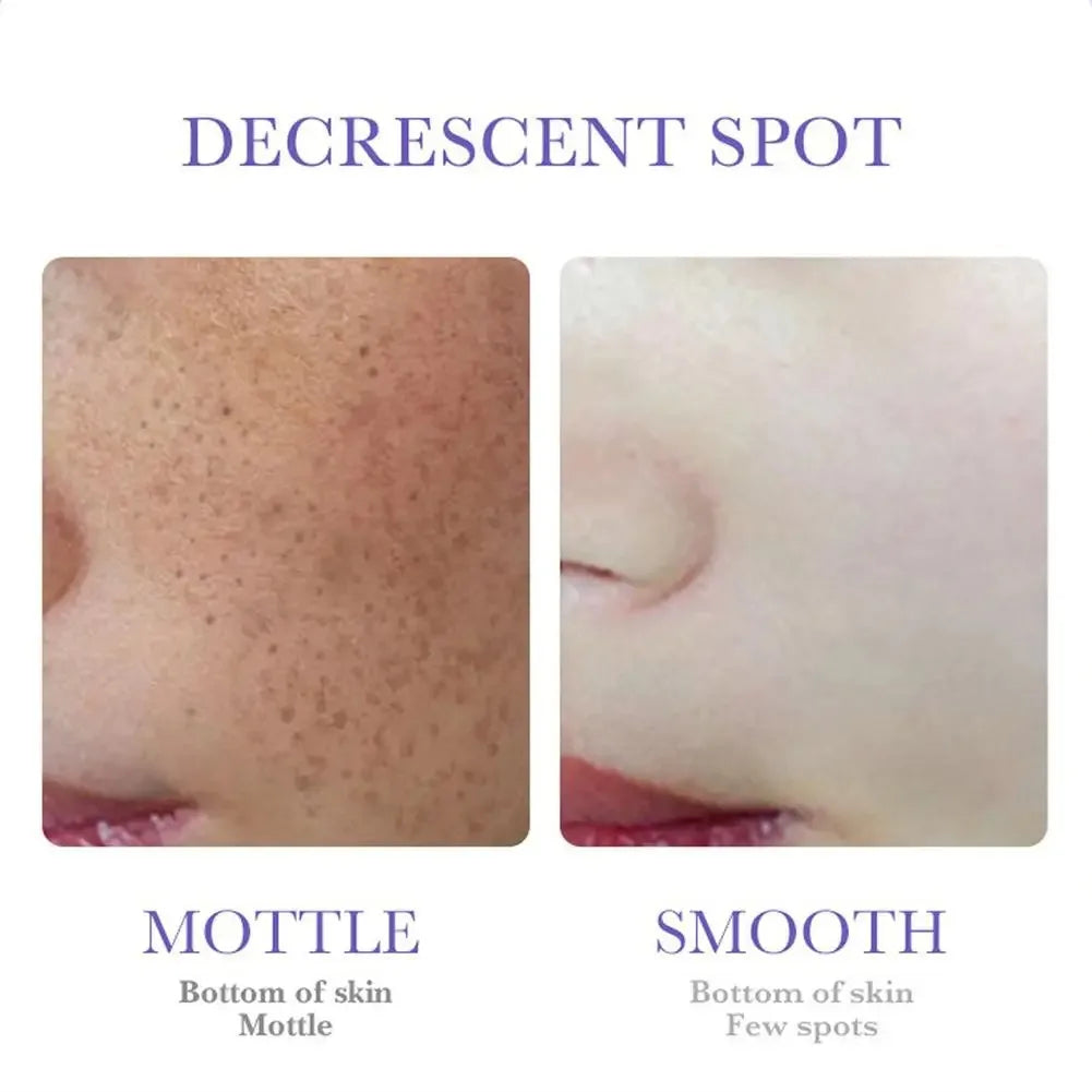 SADOER Freckle Removing Cream — Nicotinamide Moisturizing Face Cream for Hydrating, Nourishing & Firming Skin