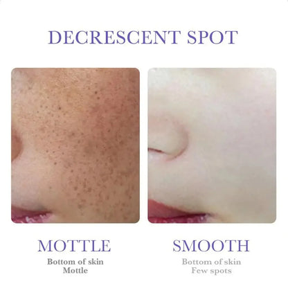 SADOER Freckle Removing Cream — Nicotinamide Moisturizing Face Cream for Hydrating, Nourishing & Firming Skin