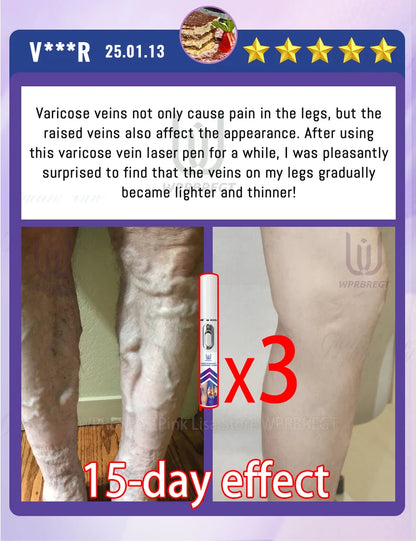 2nd Gen Varicose Vein Laser Therapy Device – Relieves Spider Leg Pain, Treats Vasculitis & Phlebitis