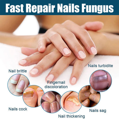 Fungal Nail Laser Device – Fast Toenail & Fingernail Fungus Repair, Onychomycosis Treatment for Hand & Foot Care