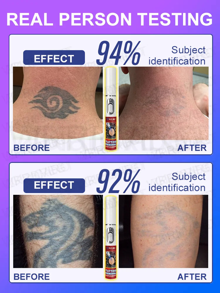 Laser Tattoo Removal Pen – Effective Portable Tattoo Eraser